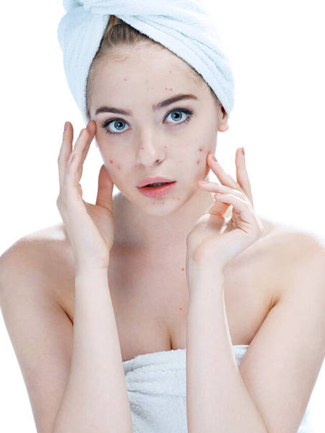 Foods To Reduce Acne Flare-Ups